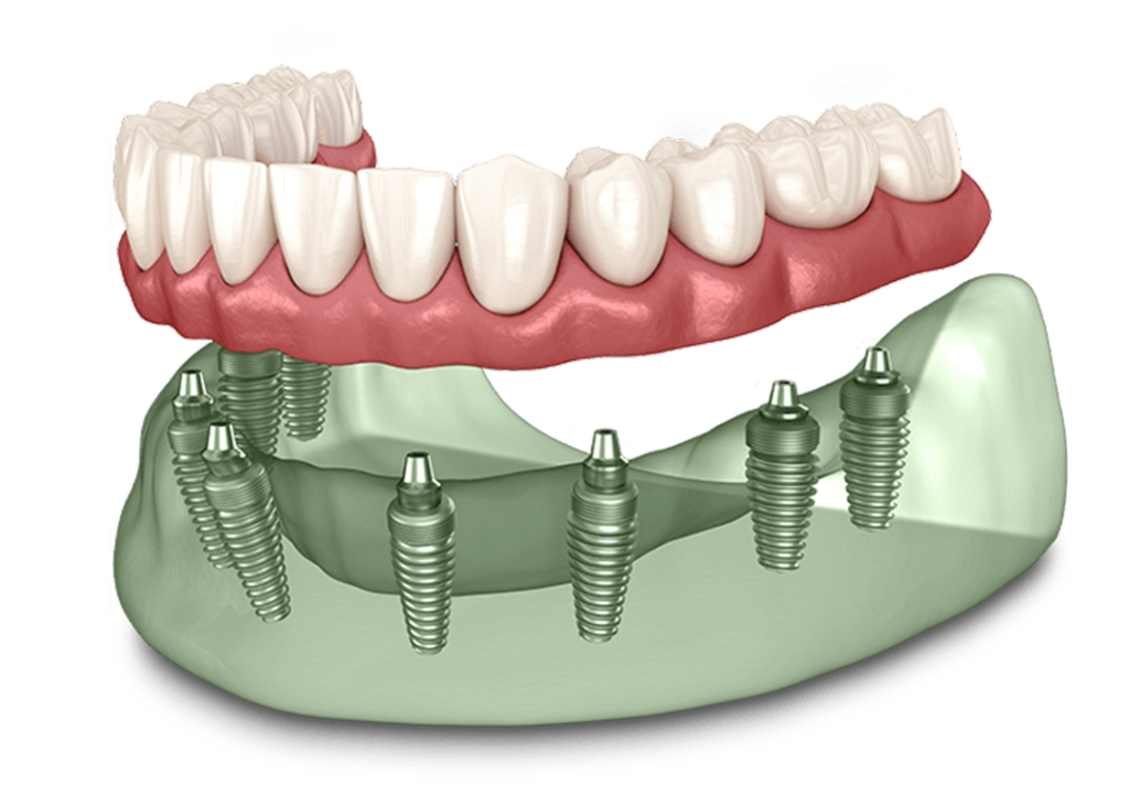 Riabilitazione dell’intera arcata dentaria